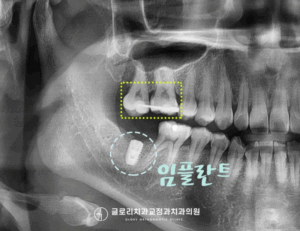 Read more about the article 치아 정출로 인한 어금니 부분교정 중화동 치과 에서 도와드린 임플란트 병행 함입 과정은?