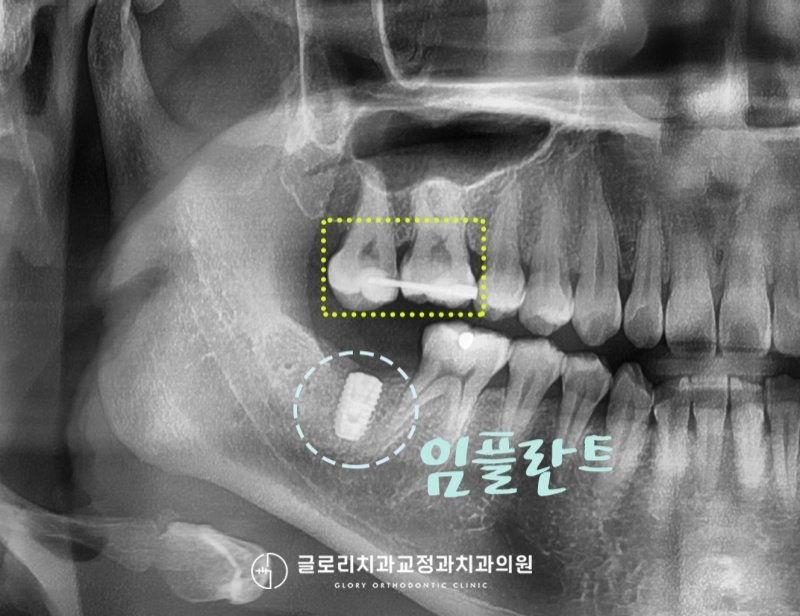 You are currently viewing 치아 정출로 인한 어금니 부분교정 중화동 치과 에서 도와드린 임플란트 병행 함입 과정은?