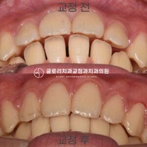 Read more about the article 신내동 글로리 교정치과 비발치 증례, 벌어진 치아 사이 공간이 고민이라면? 클릭!