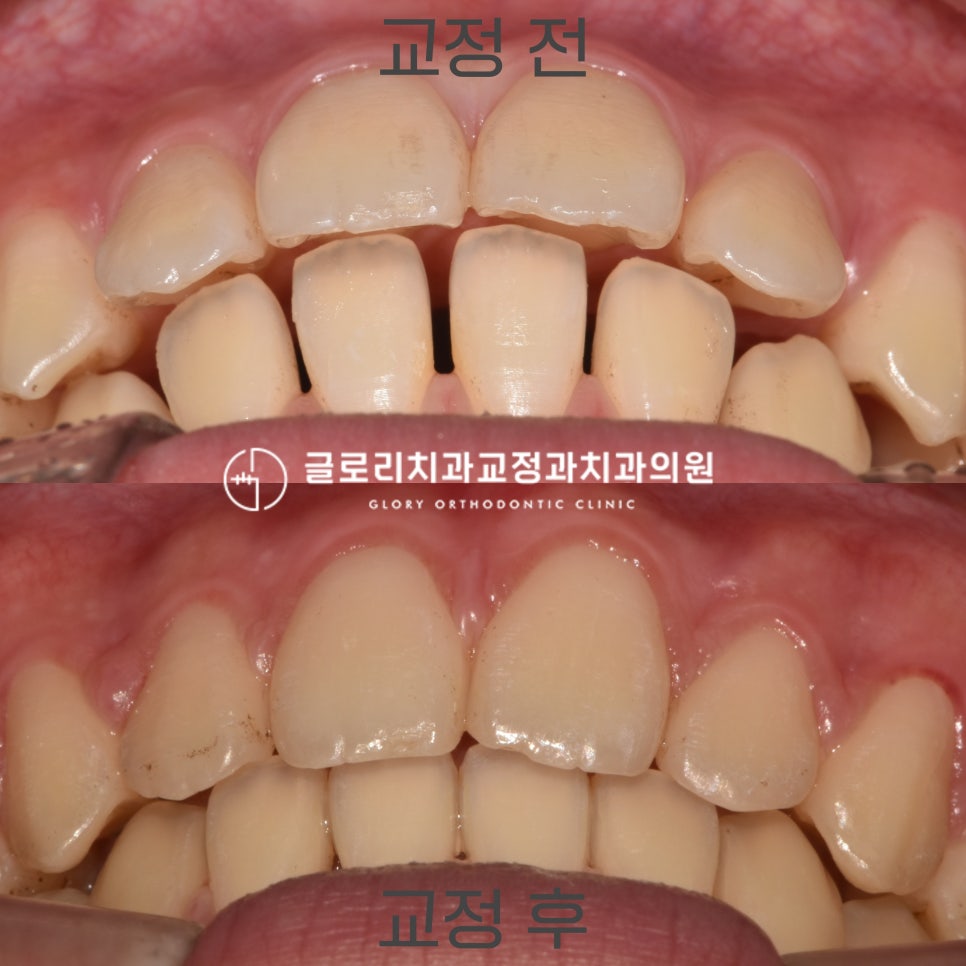 You are currently viewing 신내동 글로리 교정치과 비발치 증례, 벌어진 치아 사이 공간이 고민이라면? 클릭!