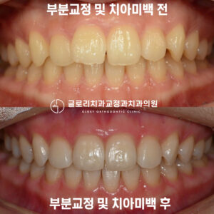 Read more about the article 망우동 치과 부분교정, 치아미백으로 웨딩 촬영 전, 환한 미소로 개선을 도와드렸습니다.