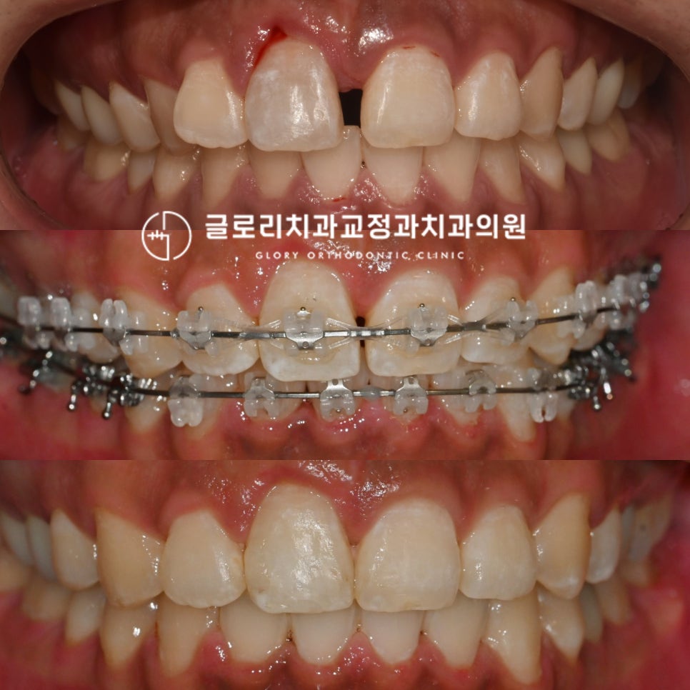 You are currently viewing 벌어진 앞니 사이 공간, 망우동 치과 전체 교정으로 긴밀한 교합 만들기