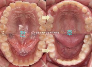 Read more about the article 반대 교합 교정 주걱턱 인비절라인으로 해결이 될까? 망우동 치과추천