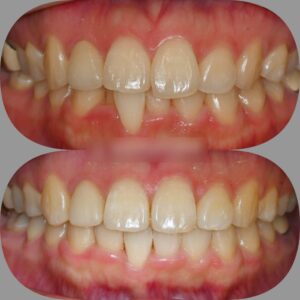 Read more about the article 어금니에 임플란트를 심어놨어도 교정이 가능한가요? 중화동 치과