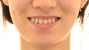 Read more about the article 치료 후 교합이 잘 안맞을때? 남들 모르게 하는 망우동 교정치과 비발치 클라리티(Clarity Ultra) 재교정