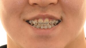 Read more about the article 골격성 3급 부정교합으로 인한 앞니 반대교합, 상봉동 교정치과 비발치 교정으로 해결한 사례