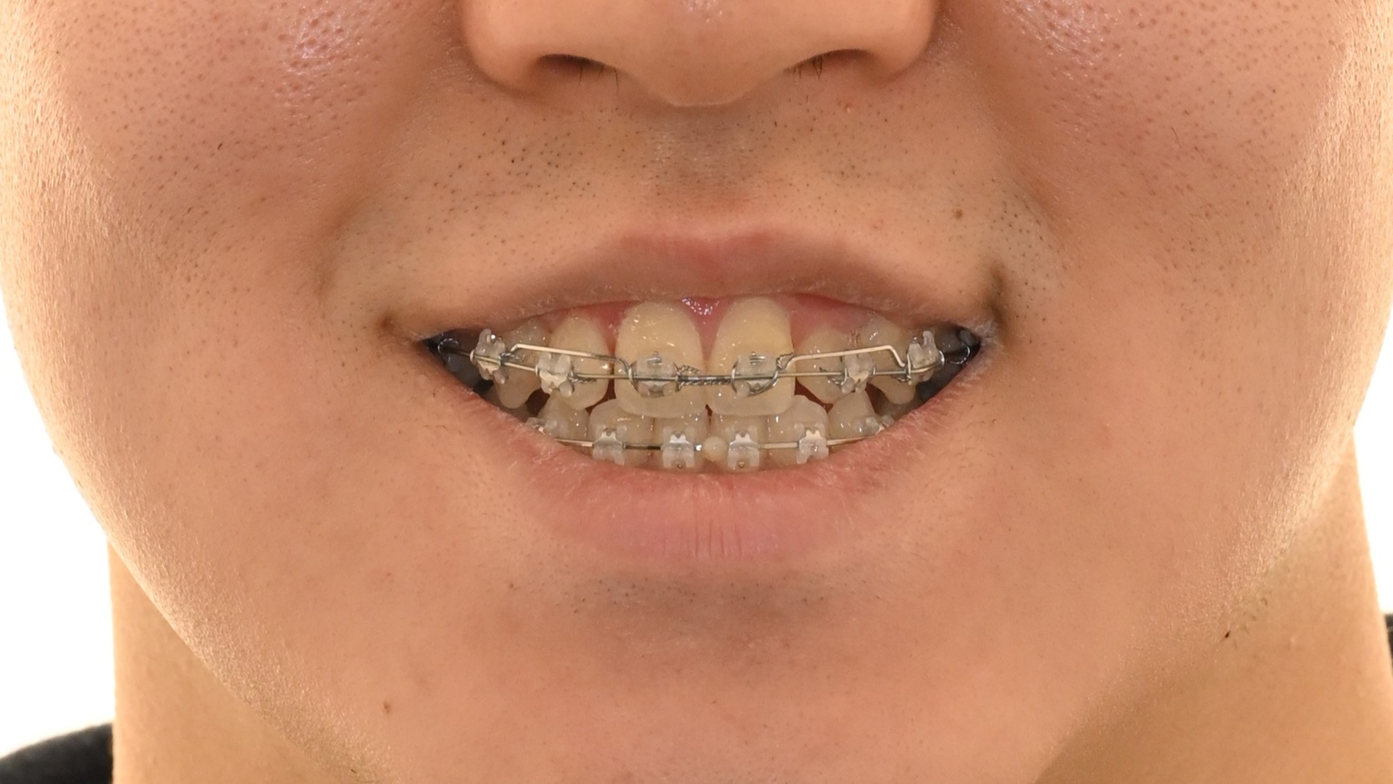 You are currently viewing 골격성 3급 부정교합으로 인한 앞니 반대교합, 상봉동 교정치과 비발치 교정으로 해결한 사례