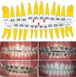 Read more about the article 상봉역 교정치과 실제사례. 위아랫니가 뜨는 개방교합, 교정으로 해결가능할까?