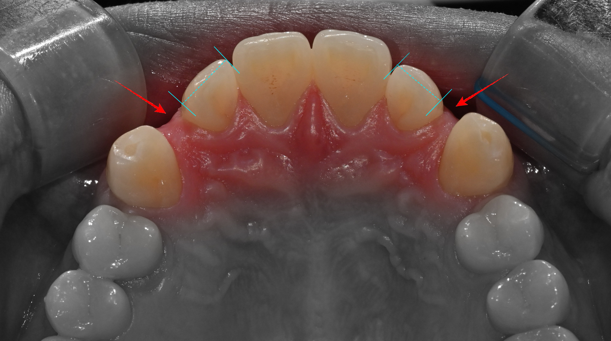 You are currently viewing 중랑구 인비절라인 비발치 교정 – 왜소 측절치 교정과 크라운, 순서가 중요한 이유?