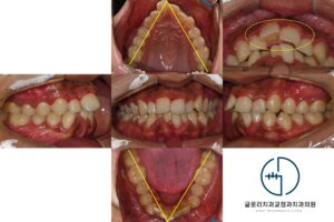 Read more about the article 상봉역 교정치과 좁은 악궁(V-shaped arch)으로 인한 심한 총생, 어떻게 해결할까?