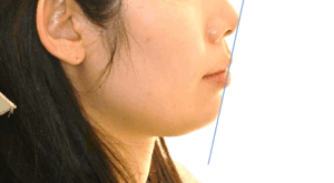 Read more about the article 상봉동 교정치과 비발치교정 과정, 치아를 뽑지 않고도 불규칙한 치열 & 돌출입 개선할 수 있을까?