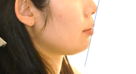 상봉동 교정치과 비발치교정 과정, 치아를 뽑지 않고도 불규칙한 치열 & 돌출입 개선할 수 있을까?