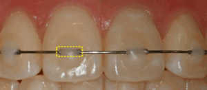 Read more about the article 망우동 치과 앞니 부분교정 미니튜브(MTA), 짧은 기간 안에 자연스러운 미소 완성하기
