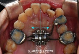Read more about the article 상악골확장 (MARPE) 동반 발치교정으로 잇몸건강까지 개선한 25개월 간의 치료