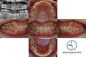 Read more about the article 치근흡수 있는 앞니 벌어짐, 40대, 50대 중장년층도 재교정 가능할까? 