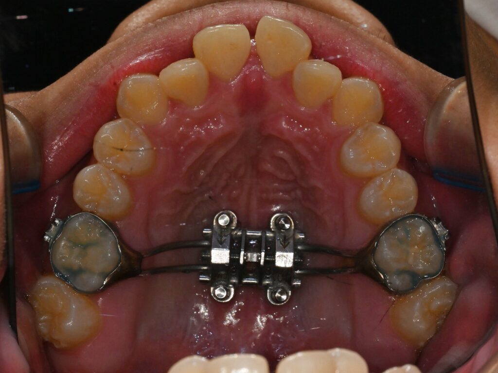 상악골 확장 으로 알아보는 비발치교정의 가능성