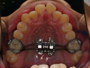 Read more about the article 상악골 확장 으로 알아보는 비발치교정의 가능성