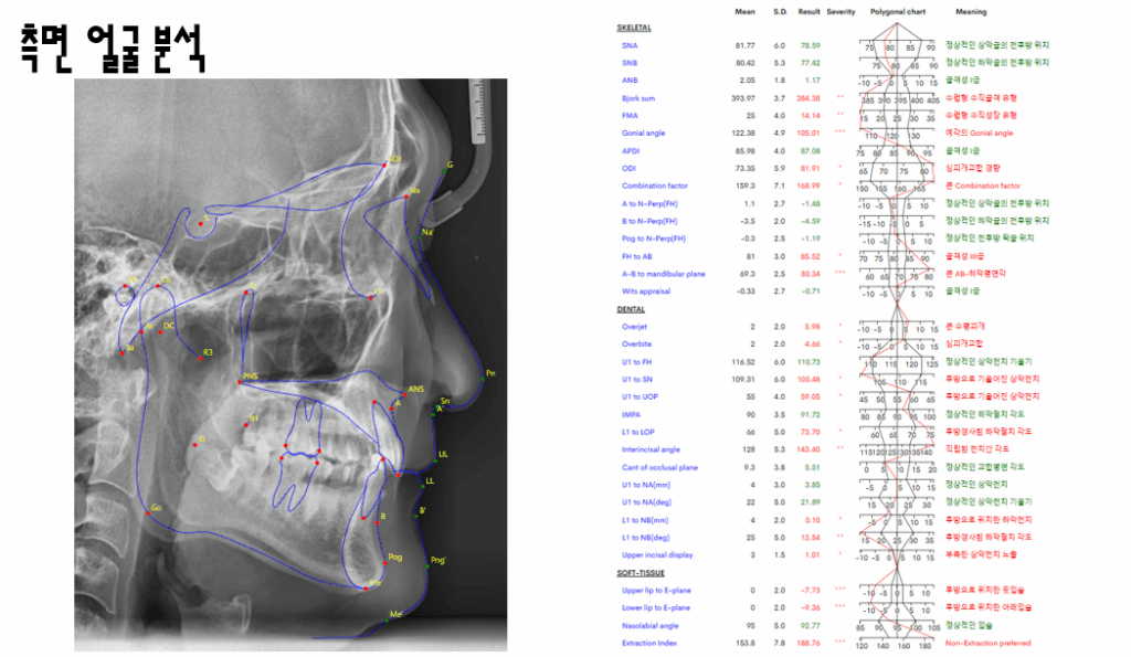 망우동 교정치과 비발치 교정, 삐뚤빼뚤한 치아? 무조건 발치교정이 답은 아닙니다.