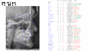 Read more about the article 망우동 교정치과 비발치 교정, 삐뚤빼뚤한 치아? 무조건 발치교정이 답은 아닙니다.