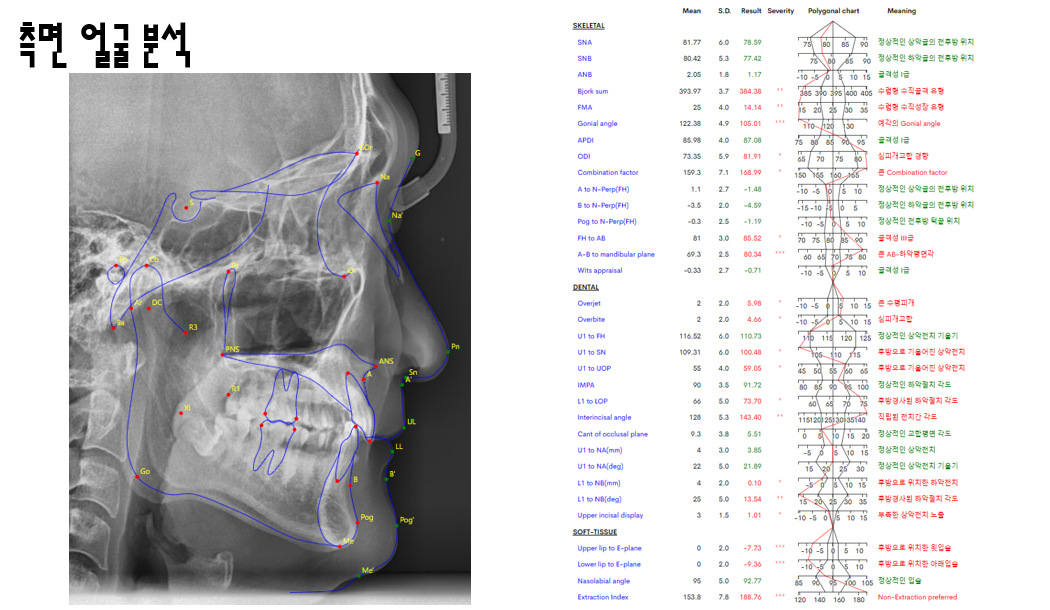 You are currently viewing 망우동 교정치과 비발치 교정, 삐뚤빼뚤한 치아? 무조건 발치교정이 답은 아닙니다.