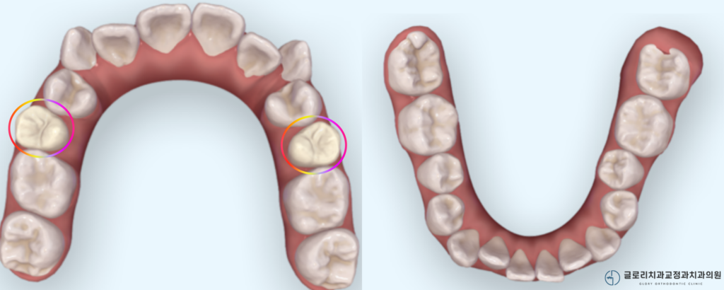 망우역 교정치과, 편악발치 교정이란? 위턱만 발치해도 교합이 맞을까?