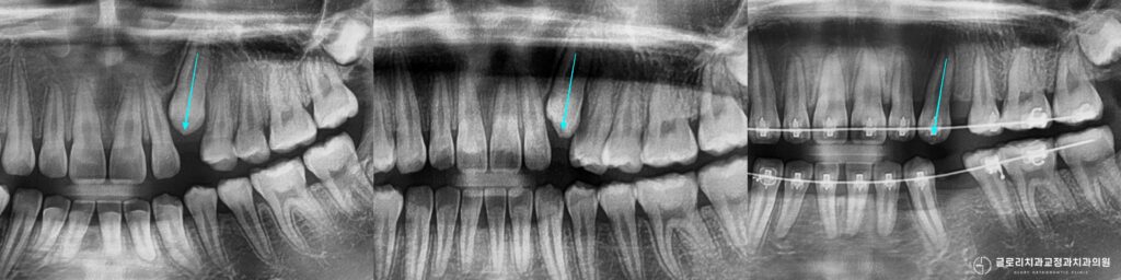 양원역 교정치과 알려주는 송곳니 매복치와 돌출입 동시 해결하기