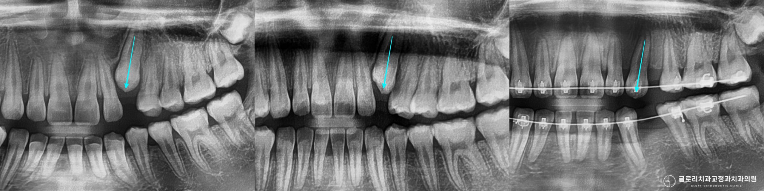 You are currently viewing 양원역 교정치과 알려주는 송곳니 매복치와 돌출입 동시 해결하기