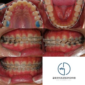 Read more about the article |상봉역 교정치과|앞니 벌어짐과 뻐드러짐, 동시에 해결하는 교정 방법