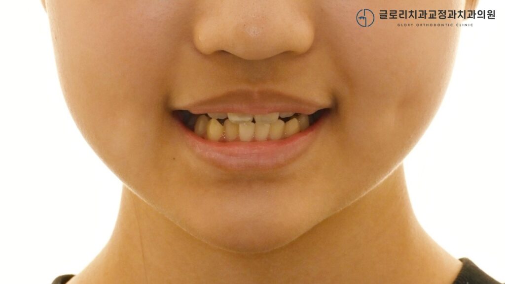 망우역 교정치과, 편악발치 교정이란?