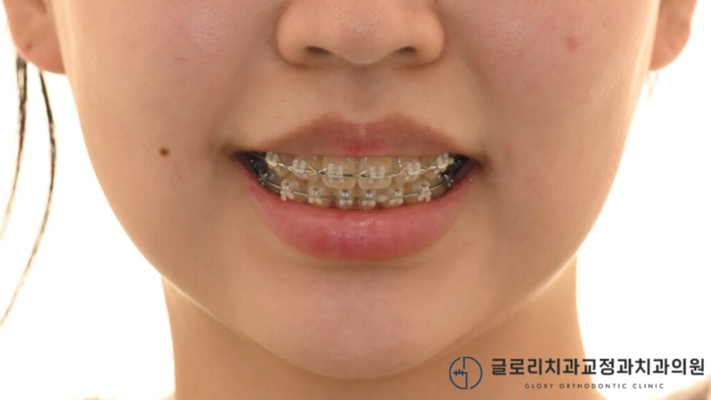 중랑구 교정치과 에서 알아보는 클리피씨 편악발치 교정!