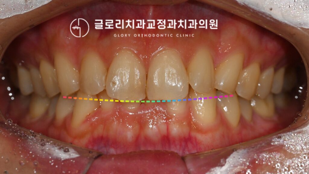 중랑구 교정치과 인비절라인이 효과적인 과개교합 치료란?