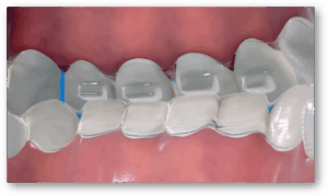 Read more about the article 중랑구 교정치과 인비절라인, 과개교합 (deepbite) 치료에 효과적인 이유?