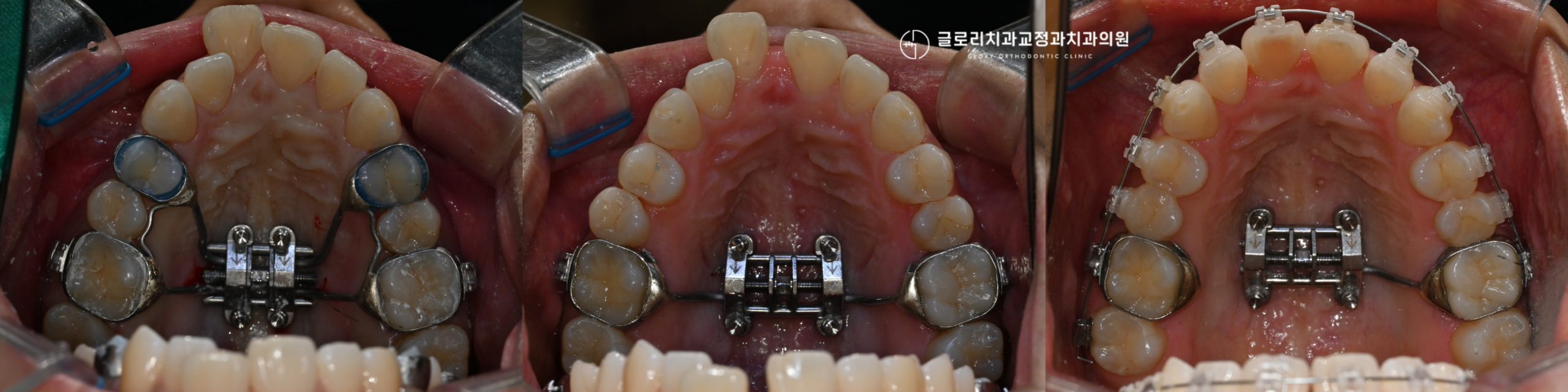 You are currently viewing 앞니 돌출과 좁은 입천장, 망우역 교정치과 상악골확장으로 비발치 교정이 가능한 경우