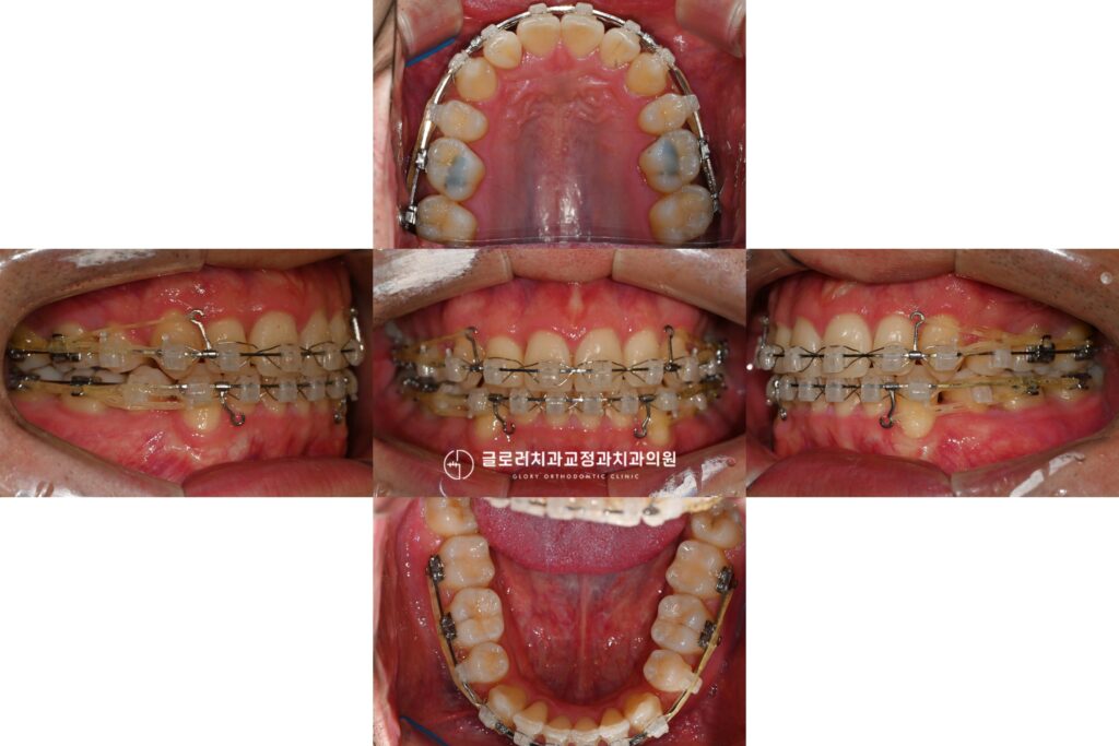 심하게 삐뚤어진 치열, 망우역 교정치과 에서 발치교정이 필요한 이유를 알려드립니다.