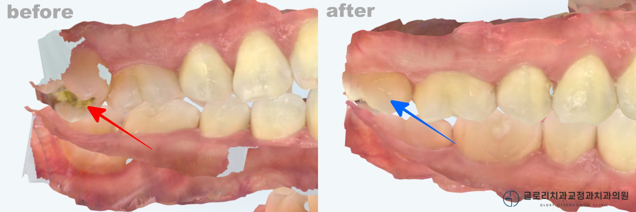 You are currently viewing 상봉역 교정치과 인비절라인으로 어금니 가위교합 치료가능할까?