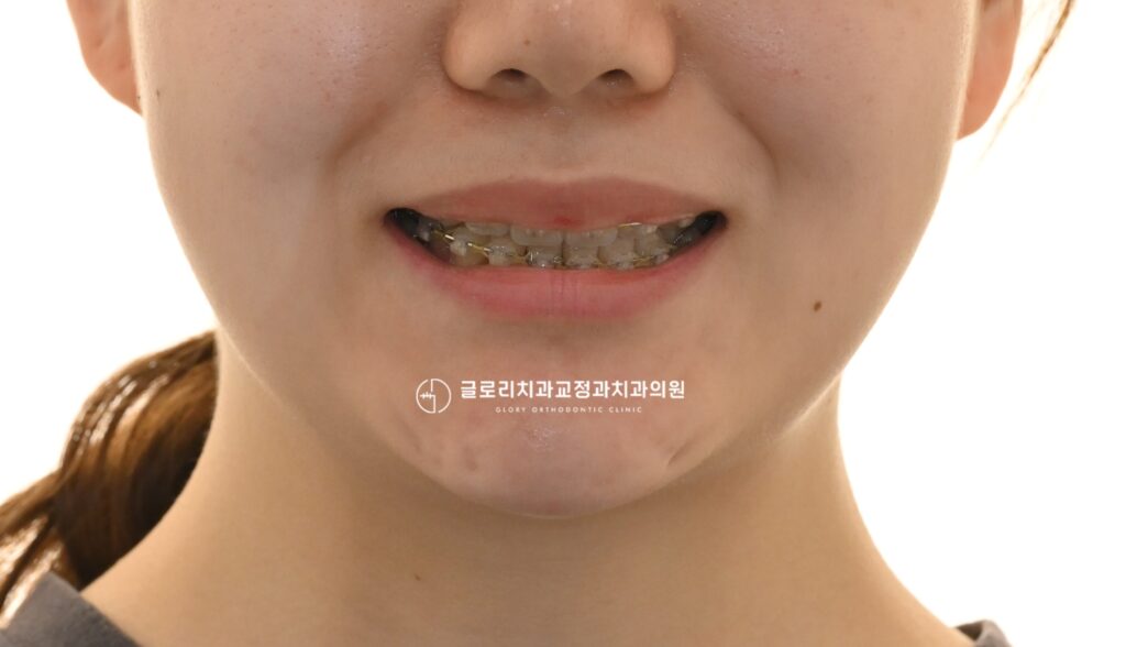 망우동 교정치과 개방교합과 돌출입, 에스라인 교정 으로 함께 개선하기
