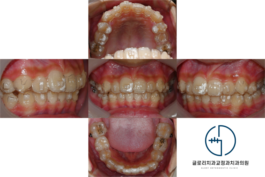 중랑구 교정치과 인비절라인 퍼스트, 우리 아이 삐뚤빼뚤한 치아도 어린이교정으로 개선될 수 있을까요?
