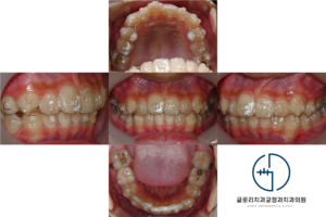 Read more about the article 중랑구 교정치과 인비절라인 퍼스트, 우리 아이 삐뚤빼뚤한 치아도 어린이교정으로 개선될 수 있을까요?
