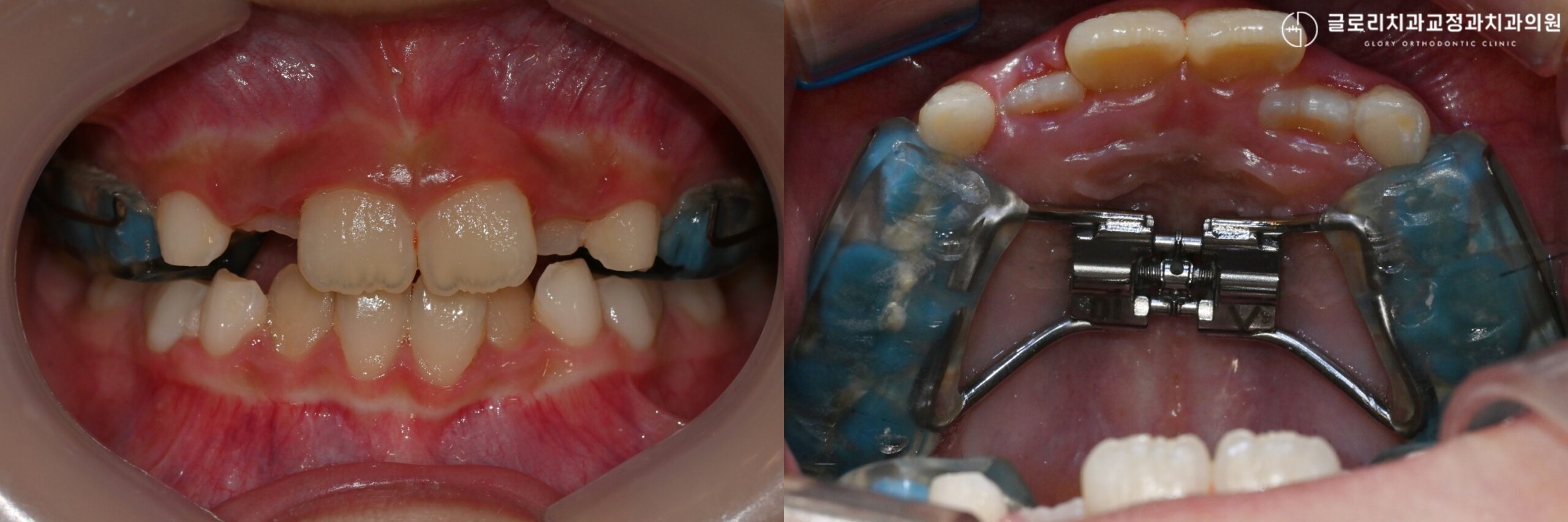 You are currently viewing 어린이 덧니교정, 상악골 확장 으로 시작하는 1차 교정치료 계획 (ft. 하악 확장장치도 있나요?)