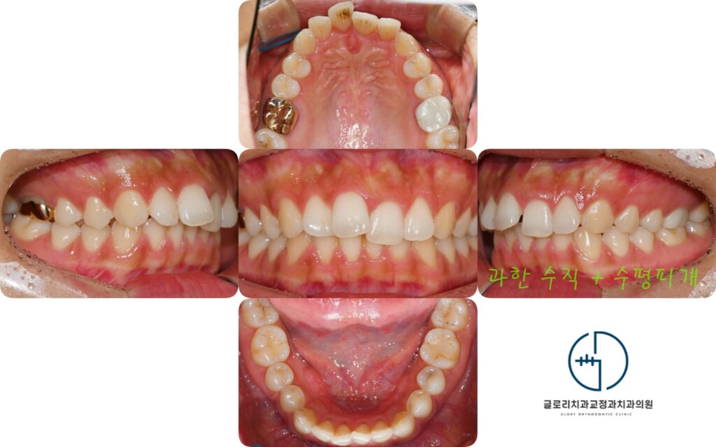 상봉역 교정치과 구치부 염증으로 인한 발치 후 교정 : 골격성 2급부정교합 개선 총과정