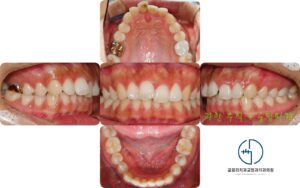 Read more about the article 상봉역 교정치과 구치부 염증으로 인한 발치 후 교정 : 골격성 2급부정교합 개선 총과정