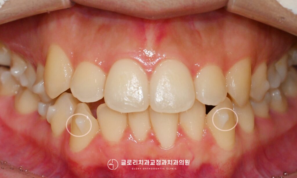 상봉동 교정치과 전치부 총생 비발치 인비절라인(투명교정)으로 가능한 이유