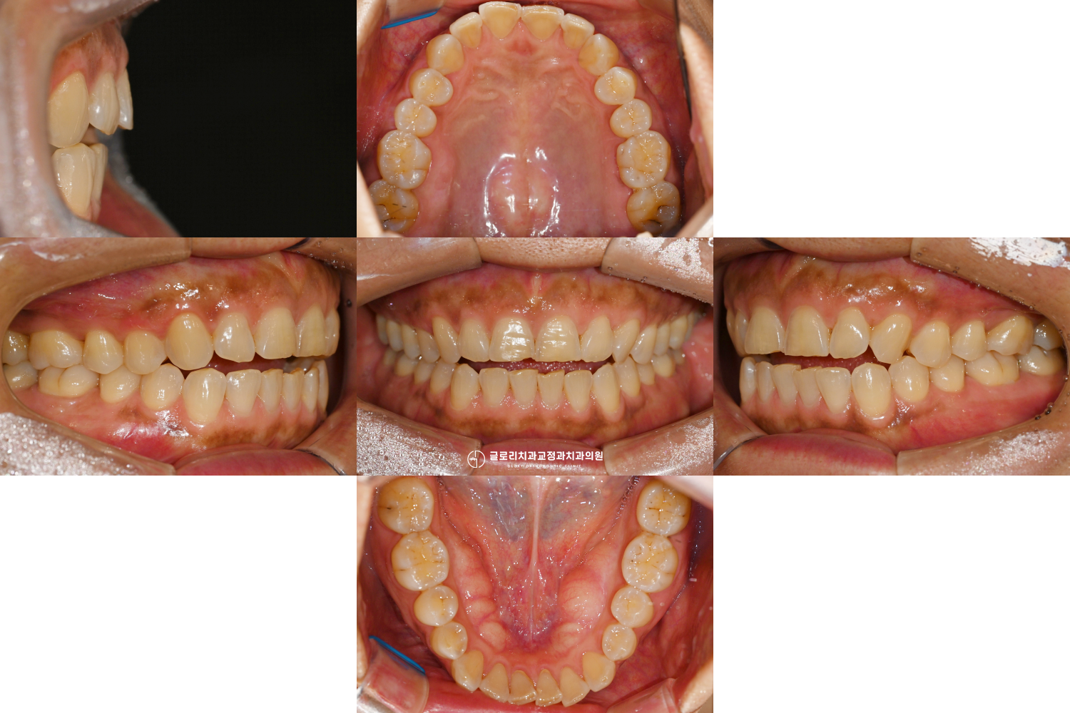 You are currently viewing 망우동 교정치과 앞니가 안 닿는 개방교합, 비발치 인비절라인 투명 교정 과정