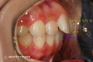 Read more about the article 망우동 교정 치과 전치부 총생과 과개교합으로 돌출된 얼굴, 발치교정을 통한 개선 과정 알아봅시다.