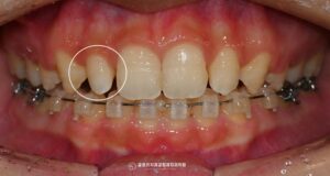 Read more about the article 상봉역 교정치과 앞니 벌어짐 발치 교정 및 왜소치 라미네이트 과정