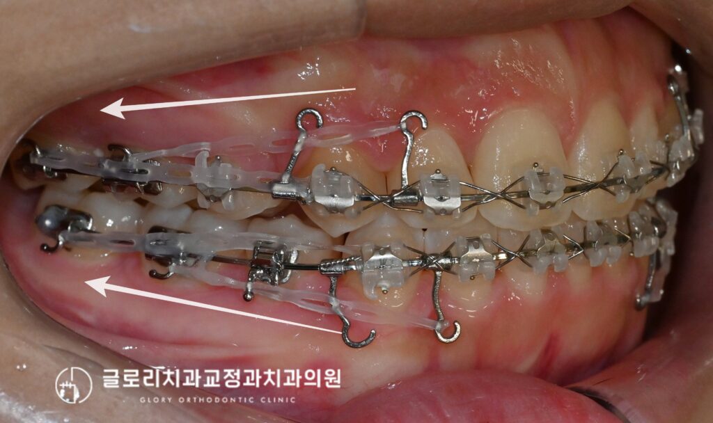 중랑구 교정치과 앞니가 삐뚤고 입이 나와보인다면? 발치교정을 통한 골격성 2급부정교합 개선 가능합니다.