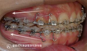 Read more about the article 중랑구 교정치과 앞니가 삐뚤고 입이 나와보인다면? 발치교정을 통한 골격성 2급부정교합 개선 가능합니다.