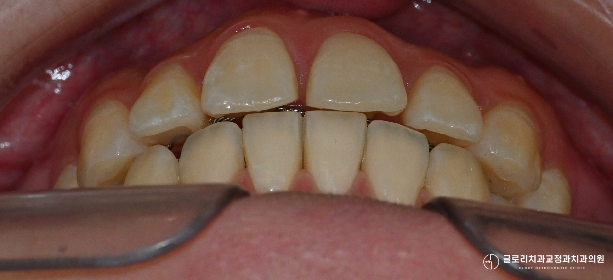 You are currently viewing 중랑구 교정치과 에서 알려드리는 세라핀 교정, 윗앞니 벌어짐 재교정