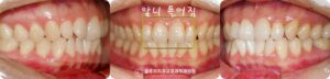 Read more about the article 중화동 치과 삐뚤어진 앞니, 윗니만 치료하고싶어요, 미니튜브를 이용한 상악 부분교정
