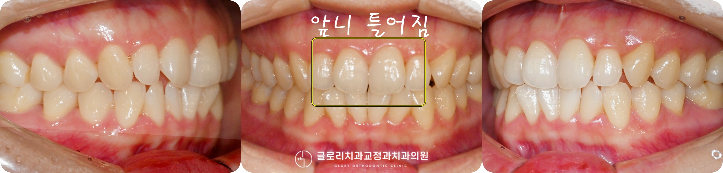 You are currently viewing 중화동 치과 삐뚤어진 앞니, 윗니만 치료하고싶어요, 미니튜브를 이용한 상악 부분교정
